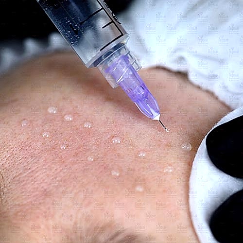 Мезотерапия в эстетической косметологии. 36 баллов Мезотерапия в эстетической косметологии. 36 баллов