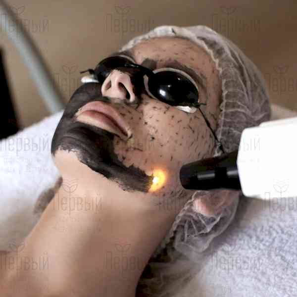 Карбоновый пилинг Карбоновый пилинг