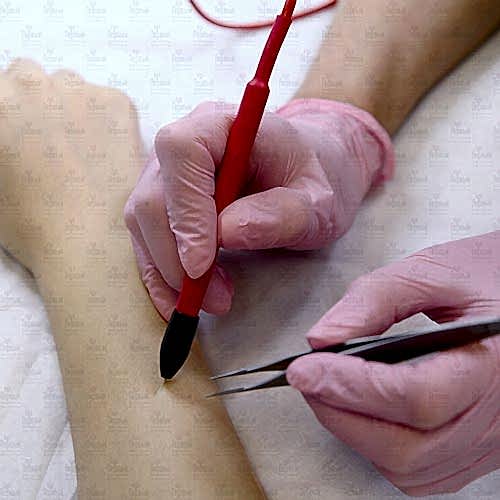 Электроэпиляция. 36 баллов Электроэпиляция. 36 баллов