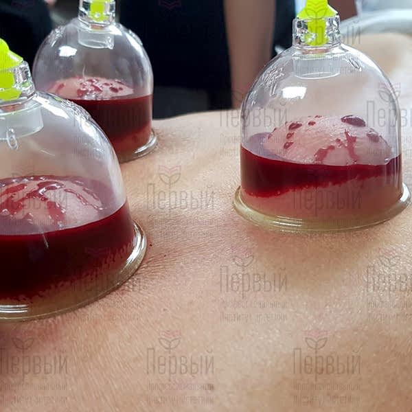 Оздоровительная хиджама Оздоровительная хиджама